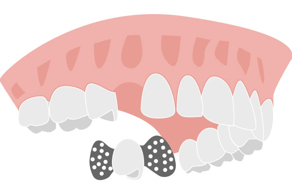 Wurzelkanalaufbereitung