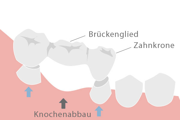 Bild einer Vollgusskrone