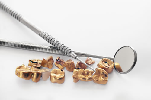 Gold-Inlays - Langlebigkeit durch höchste Präzision