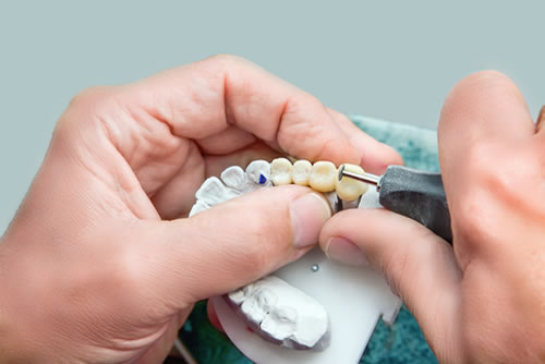 Keramik-Inlays - Anspruchsvolle, lebendige Ästhetik