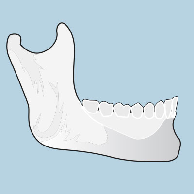 Wurzelkanalaufbereitung