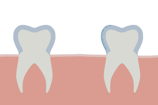 Wurzelkanalaufbereitung