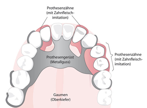 Modellgussprothesen - Die Grundversorgung