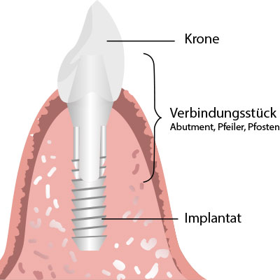Bild eines Implantats