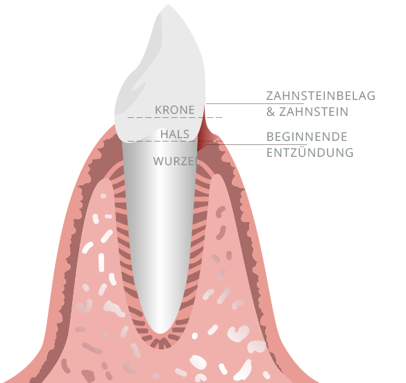 Zahnbelag & Zahnstein - beginnende Entzündung