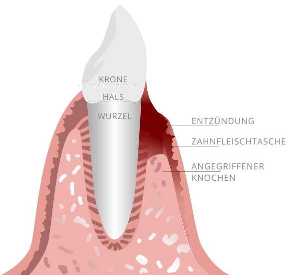 Entzündung, Zahnfleischtasche, angegriffener Knochen