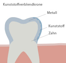 Bild einer Vollgusskrone